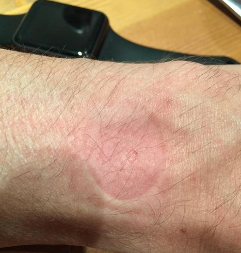 Some Apple Watch users complained about skin irritation upon wearing the device