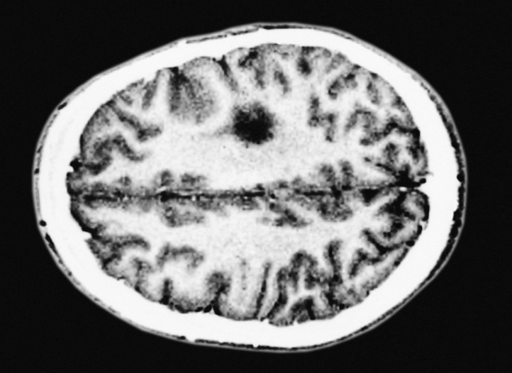 Brain Cancer Cells becoming cancerous due to Genome misfolding