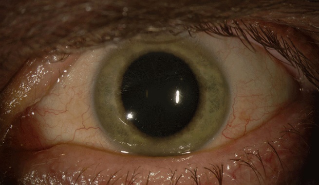 Virus can hide inside your eyeballs without making you feel sick
