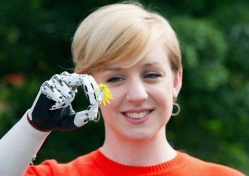 Woman from London Gets World's Most Advanced Bionic Hand Replacement