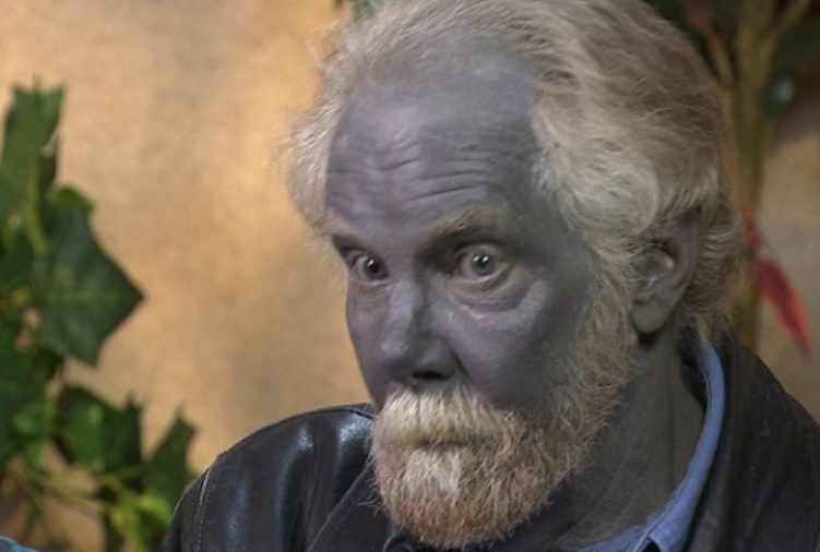 Paul Karason The Man who accidentally turned himself blue